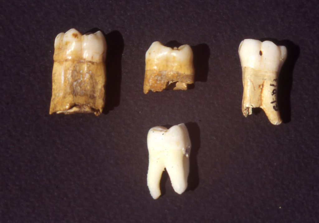 The three ‘bull-teeth’ or taurodont molars at the top at the start of the investigation in 1994; they contrast significantly with a modern tooth below, in size, shape and coloration; their crown surfaces are also evidently different. See below.